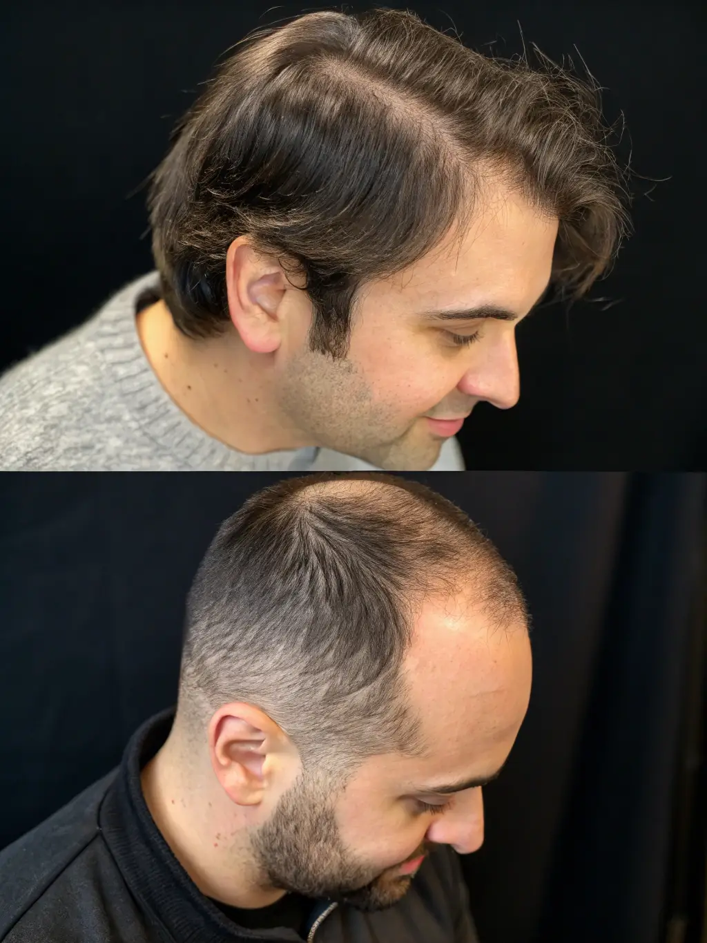 A close-up shot of a client's scalp before starting a hair loss treatment, showcasing thinning hair and visible scalp.